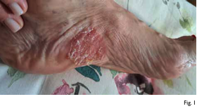 UN CASO DI PSORIASI fig1