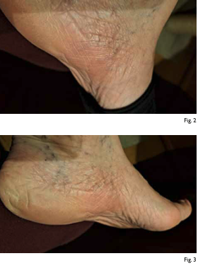 UN CASO DI PSORIASI fig2 fig3